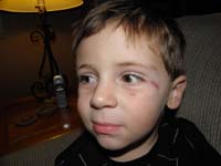 19-Kenny's_wound-hit_train_table-needed_glue_instead_of_stitches
