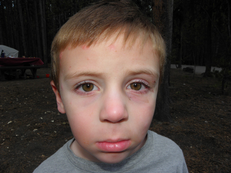 58-mosquito_bites_on_Kenny's_face