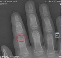 05-x-ray_image-small_fracture