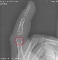 06-x-ray_image-small_fracture