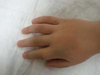 21-Kenny's_finger_with_temporary_split_off-visit_to_hand_surgeon_for_evaluation_and_cast