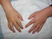 65-his_hand_is_still_a_little_swollen