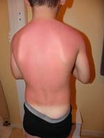78-very_bad_and_painful_sunburn_three_days_later,lots_of_aloe_and_cream