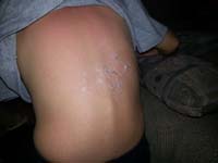 82-five_days_after_sunburn-back_is_starting_to_peel_dead_skin