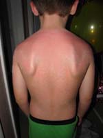 83-six_days_after_sunburn-back_is_really_peeling_dead_skin-poor_kid_has_been_in_pain_all_week