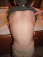 38-Sept_7_5pm-hives_on_back_starting_from_allergic_reaction_to_penicillin