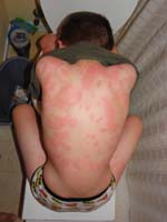 41-Sept_8_630am-really_bad_hives_on_back-nauseous-going_to_doctor-learned_allergic_to_penicillin