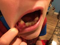14-last_non-molar_tooth_to_loose-simply_fell_out_on_its_own