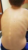 30-prick_allergy_test_to_determine_if_Kenny_is_allergic_to_food_causing_his_sudden_uncontrollable_vomiting